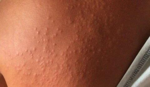 Coceira misteriosa é identificada em 79 pessoas em Pernambuco