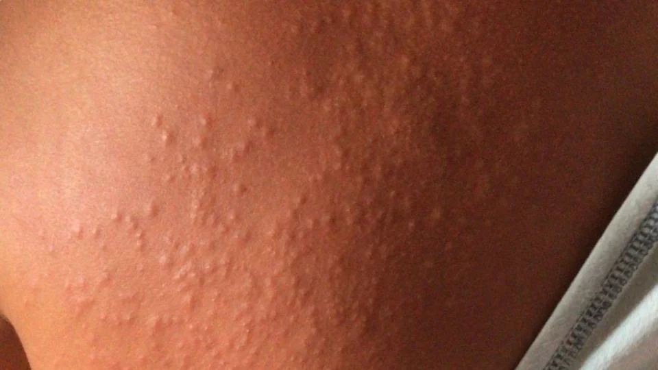 Coceira misteriosa é identificada em 79 pessoas em Pernambuco