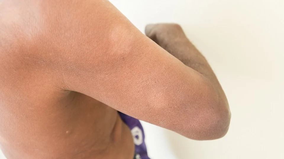 Saiba como ocorre transmissão e tratamento da hanseníase