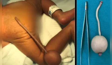 Em Fortaleza-CE, bebê nasce com ‘cauda’ de 12 centímetros e bola na extremidade