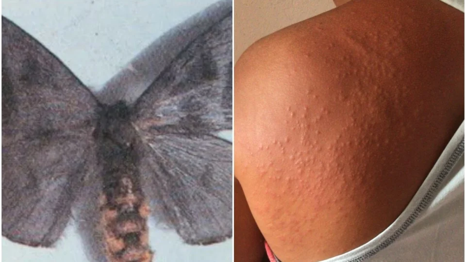 Mariposas são responsáveis por surto de coceira em Recife, diz Sociedade Brasileira de Dermatologia