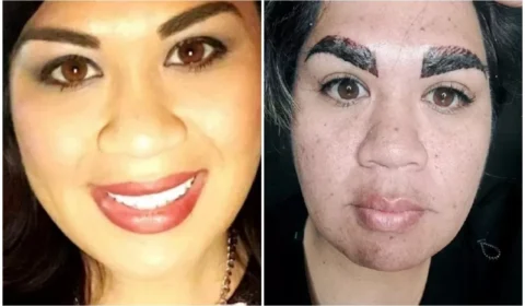 Mulher gasta R$ 1,7 mil em procedimento e fica com sobrancelha ‘assustadora’, nos EUA