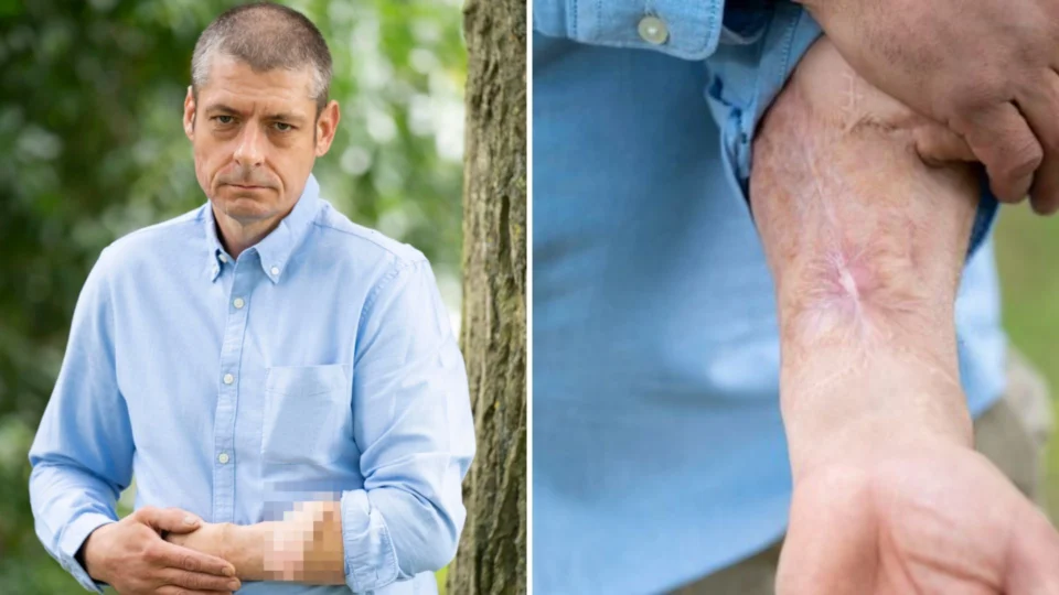 Homem fica com pênis anexado ao braço por 6 anos, na Inglaterra