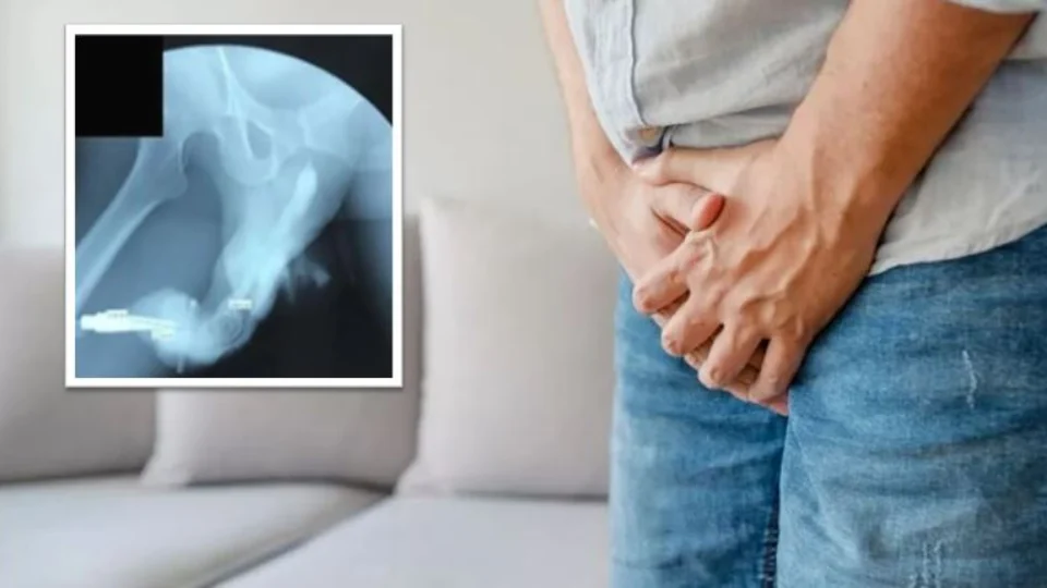 ‘Deformidade berinjela’: homem fratura órgão genital durante relação sexual na Indonésia