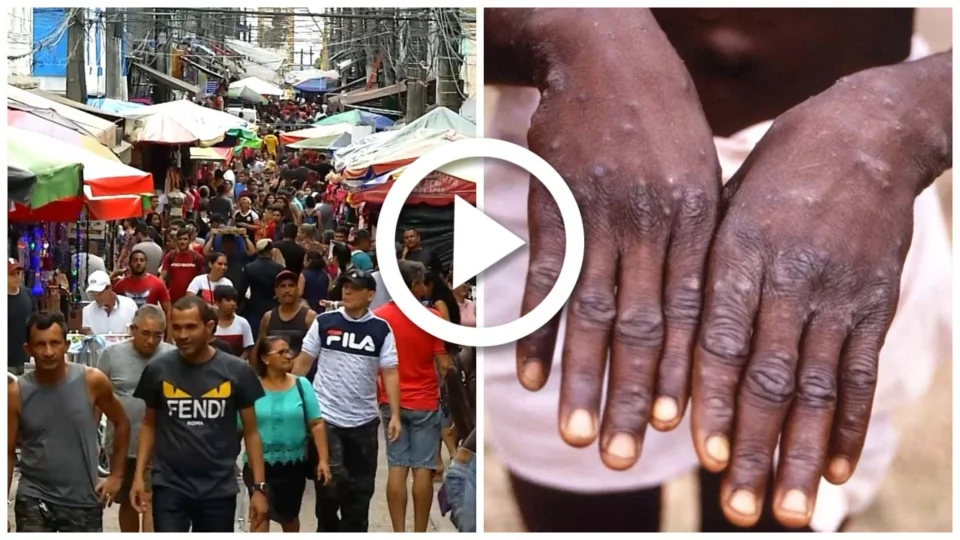 VÍDEO: casos de varíola dos macacos são confirmados no Brasil