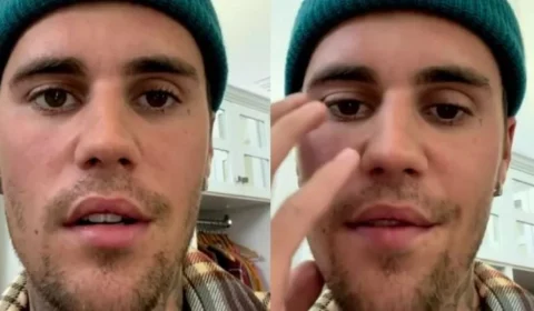 Justin Bieber assusta fãs ao dizer que está com metade do seu rosto paralisado