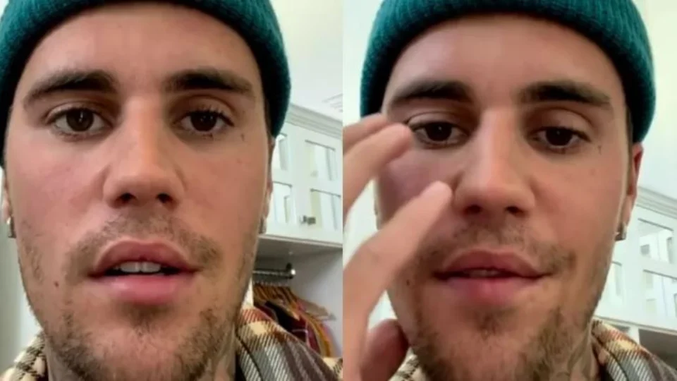Justin Bieber assusta fãs ao dizer que está com metade do seu rosto paralisado