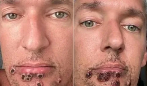 Ator pornô norte-americano publica evolução da varíola dos macacos em rede social