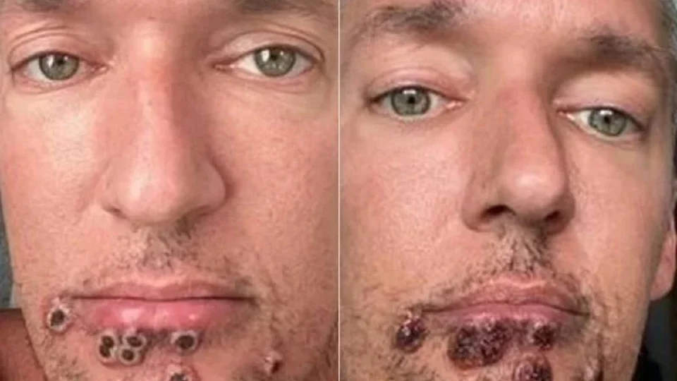 Ator pornô norte-americano publica evolução da varíola dos macacos em rede social