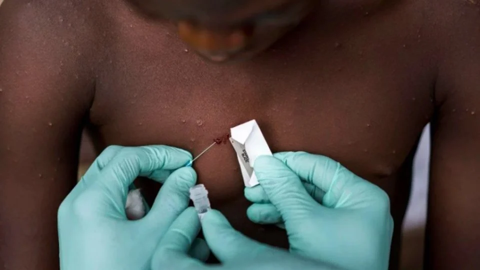 Israel confirma primeiro caso de varíola dos macacos