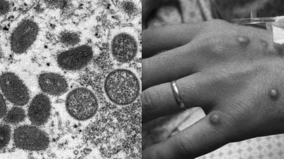 Varíola dos macacos se espalha pelo mundo e Alemanha registra primeiro caso em brasileiro