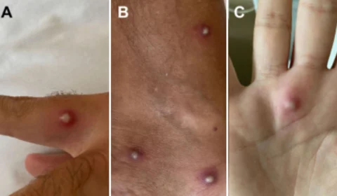 Homem testa positivo para varíola dos macacos, Covid-19 e HIV, afirmam cientistas na Itália