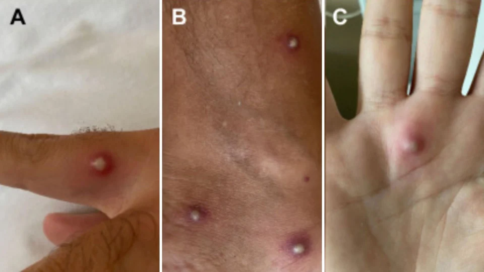 Homem testa positivo para varíola dos macacos, Covid-19 e HIV, afirmam cientistas na Itália