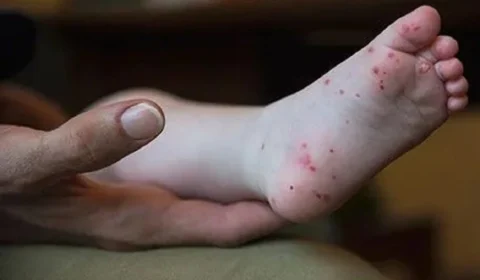 Conheça a ‘gripe do tomate’, um novo vírus que afeta 82 crianças na Índia