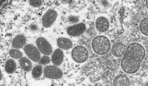 Brasil registra terceiro caso de varíola dos macacos