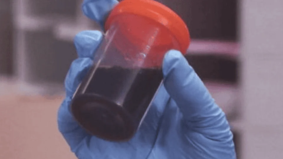 FVS-RCP investiga casos notificados da doença ‘da urina preta’ em Itacoatiara-AM