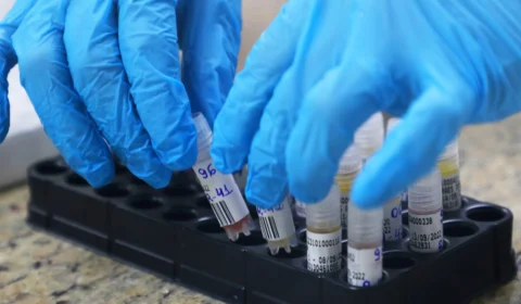 Monkeypox: Amazonas contabiliza 275 casos confirmados da doença