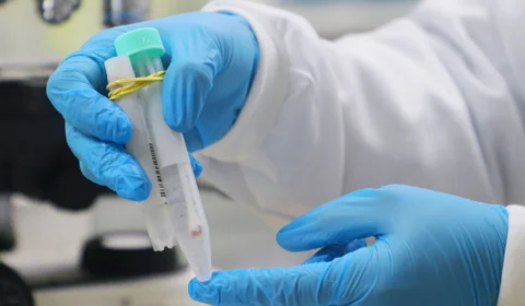 Monkeypox: Lacen passa a processar exames de diagnóstico da doença no AM