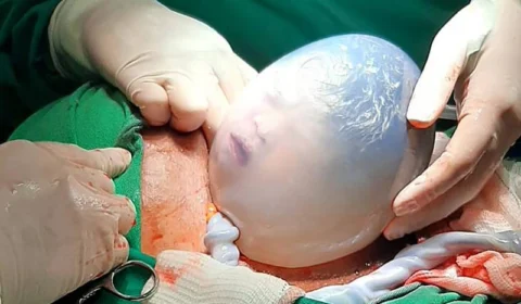 Parto raro: gêmea nasce dentro da bolsa amniótica em Barcarena, no Pará