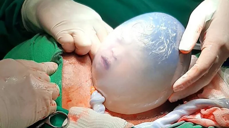 Parto raro: gêmea nasce dentro da bolsa amniótica em Barcarena, no Pará