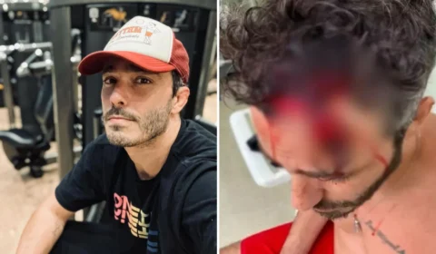Thiago Rodrigues perde parte do couro cabeludo e está em choque, diz empresária