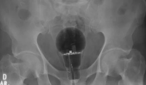 Homem põe lâmpada no ânus e vai parar no hospital com medo de avisar esposa