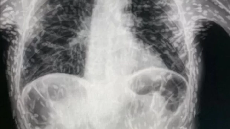 Tecnologia de empresa em SP faz diagnóstico de mesmo parasita revelado em tórax de paciente; conheça