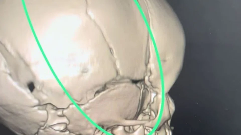 Bebê fratura crânio após cair de incubadora na Maternidade de RR