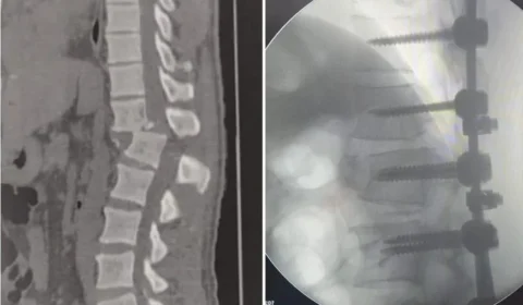 Veja antes e depois da cirurgia do homem atingido por aparelho de academia