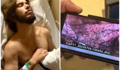 Atleta de 20 anos mostra pulmão após anos fumando cigarro eletrônico; veja