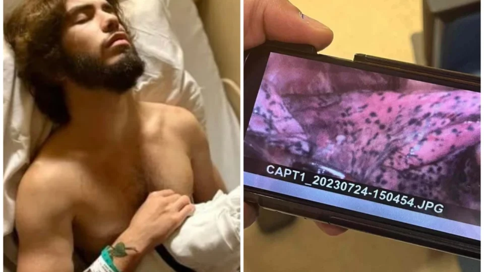 Atleta de 20 anos mostra pulmão após anos fumando cigarro eletrônico; veja