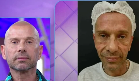 Rafael Ilha faz harmonização a convite do Fofocalizando; veja transformação