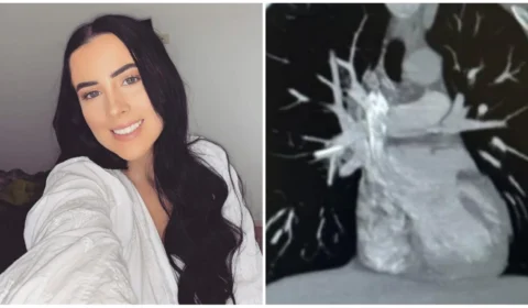 Jovem australiana retira implante contraceptivo que migrou para coração; veja