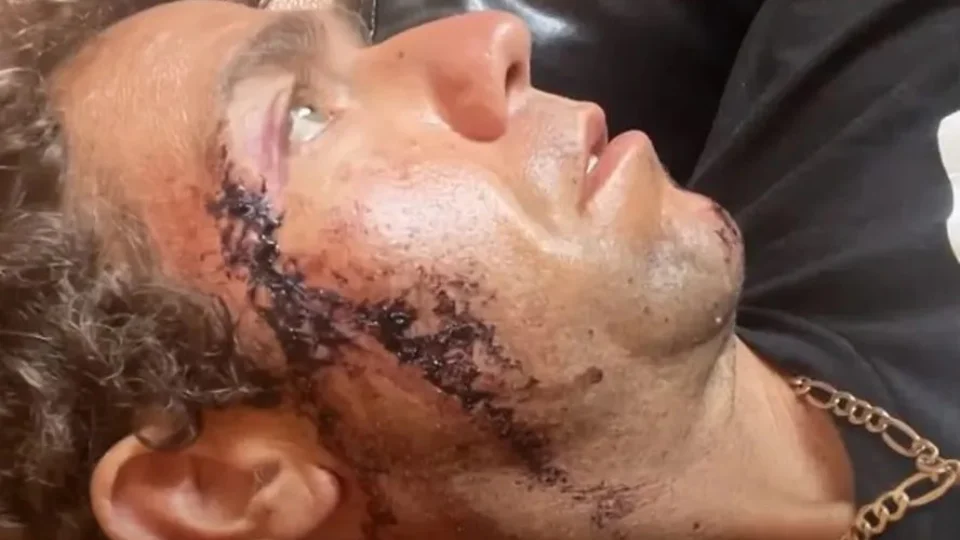 Surfista recebe mordida de tubarão no rosto em praia da Flórida-EUA