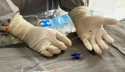 Bebê prematuro realiza procedimento cardíaco inovador no Tocantins