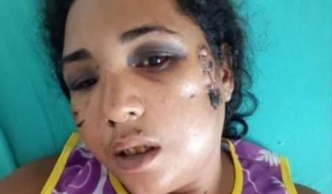 Vítima de tiro na cabeça pelo marido faz campanha para custear cirurgia no Acre