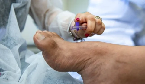 Tocantins registra alta nos casos de hanseníase, divulga SES