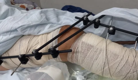 Família de paciente denuncia ao MP-RR erro cirúrgico feito no HGR