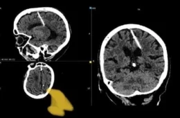 Idosa acha agulha de 3cm no cérebro após realizar exames na Rússia