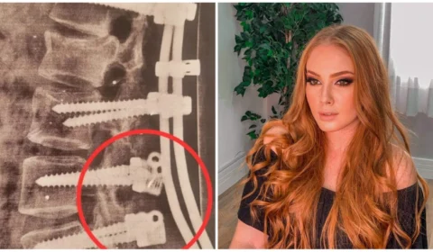 Pinos de prótese na coluna se soltam e jovem aguarda retirada em SP