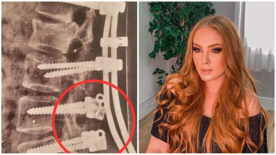 Pinos de prótese na coluna se soltam e jovem aguarda retirada em SP