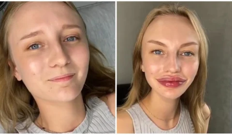 Resultado de preenchimento labial surpreende internautas; confira