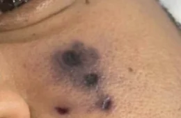 Caso Darlyn: especialista alerta sobre ataques de aranhas peçonhentas em TO