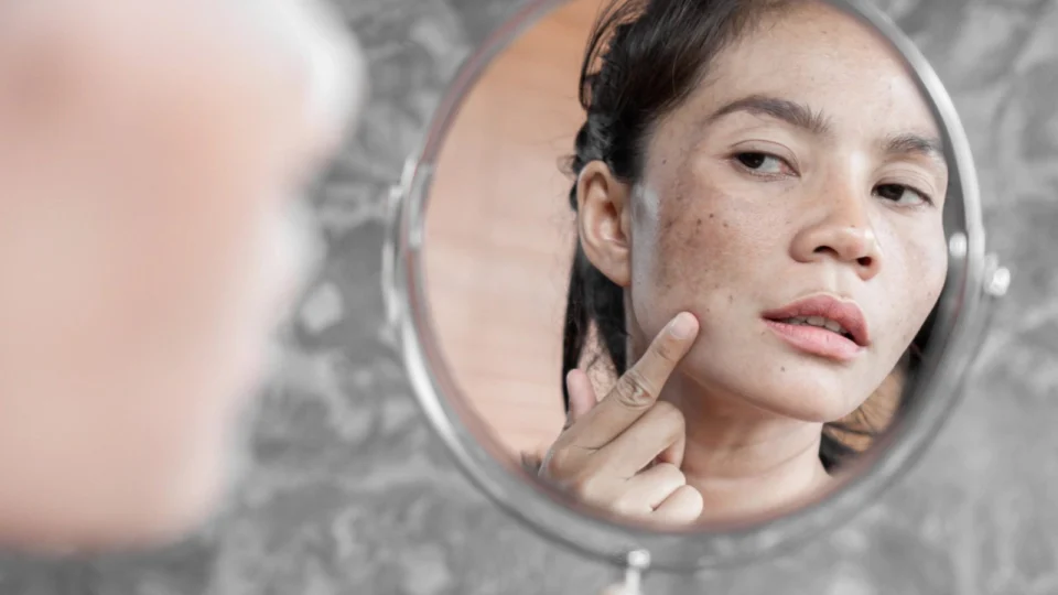 Melasma: condição afeta cerca de 35% da população feminina do Brasil