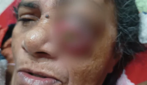 Em RR: Familiares de paciente com tumor na cabeça cobram cirurgia