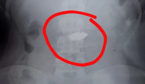 Adolescente engole corrente de R$ 10 mil após furto e objeto fica preso