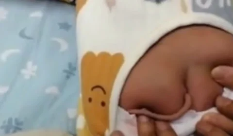 Bebê nasce com “cauda” de 10 cm