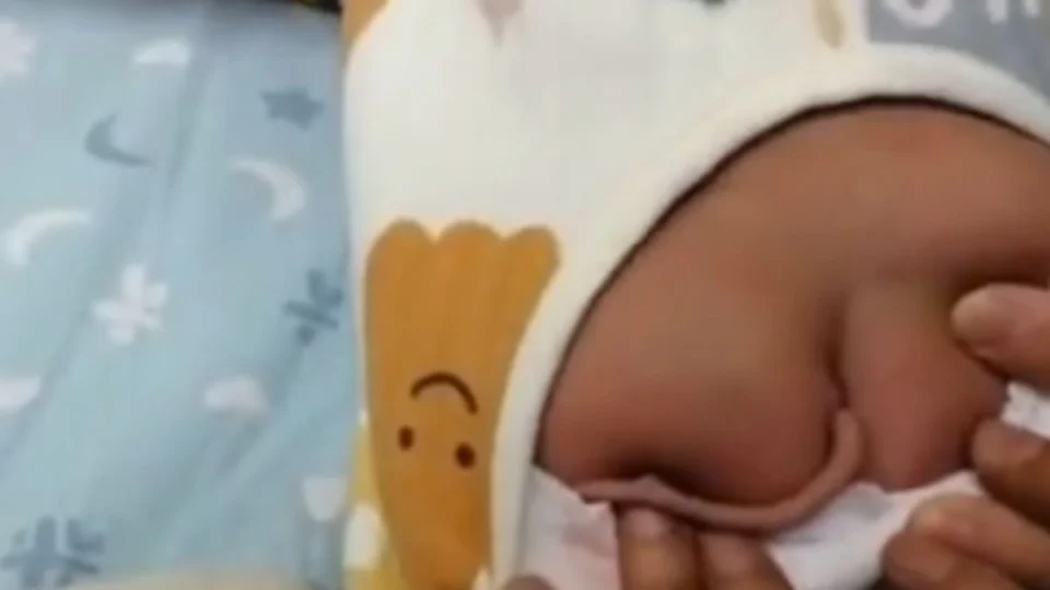 Bebê nasce com “cauda” de 10 cm