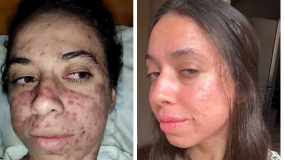 Acne Severa: influenciadora viraliza após mostrar realidade com a pele; veja vídeo