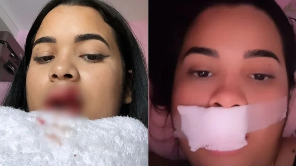 Modelo tem parte do lábio arrancado ao tentar beijar cachorro na boca